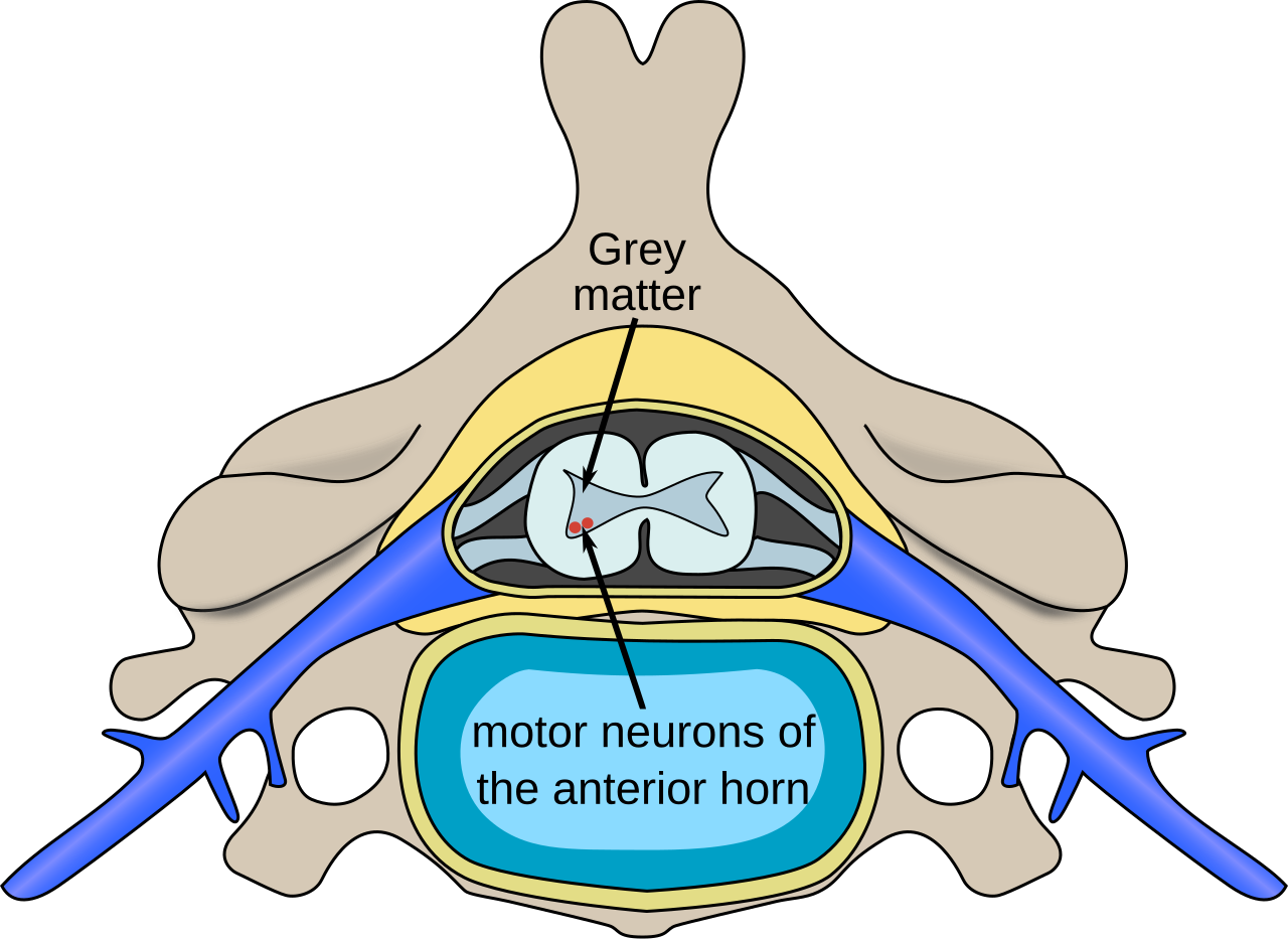 Spinal Muscular Atrophy: Understanding Causes and Progressive Weakness